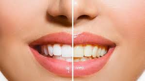 A Whiter Tomorrow: How Teeth Whitening Can Enhance Your Professional Image